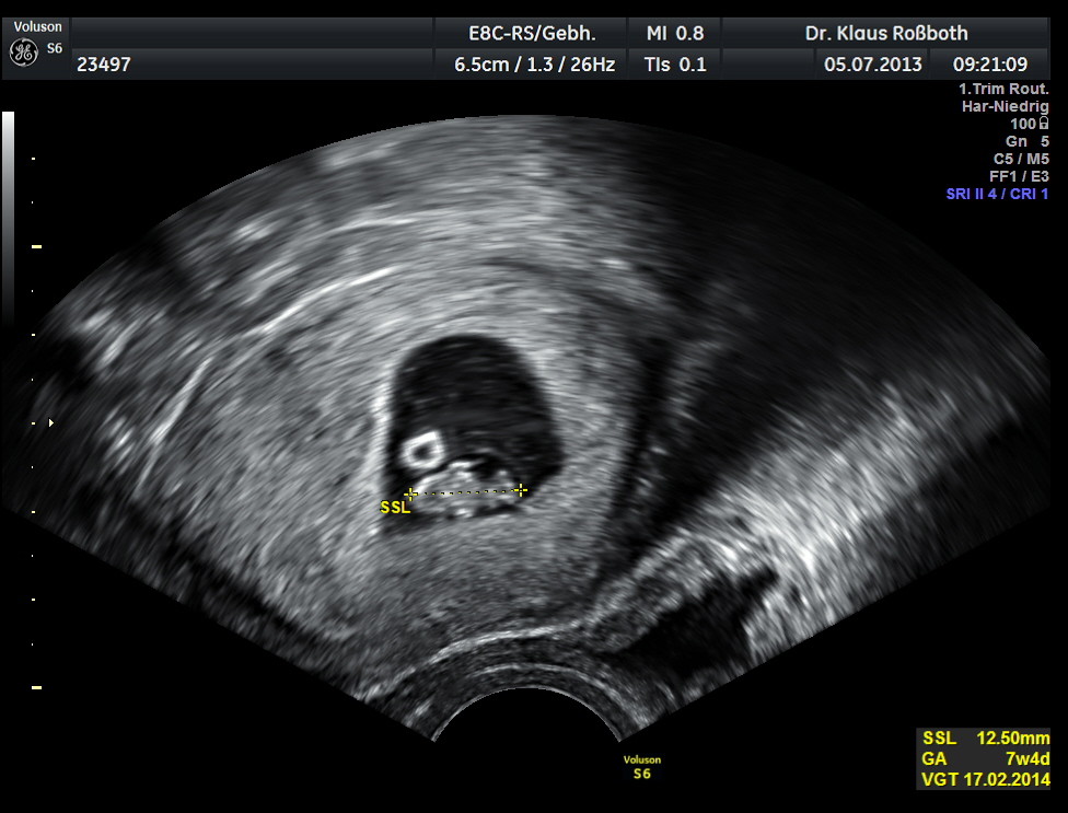 Ultraschall: Am Anfang einer Schwangerschaft sind die Ultraschallbilder am ...