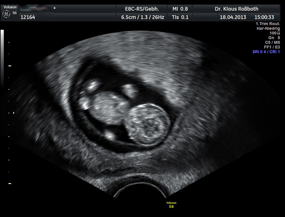 Ultraschall siebte schwangerschaftswoche SSW 7:
